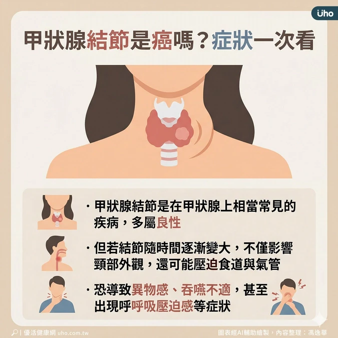 甲狀腺結節多為良性