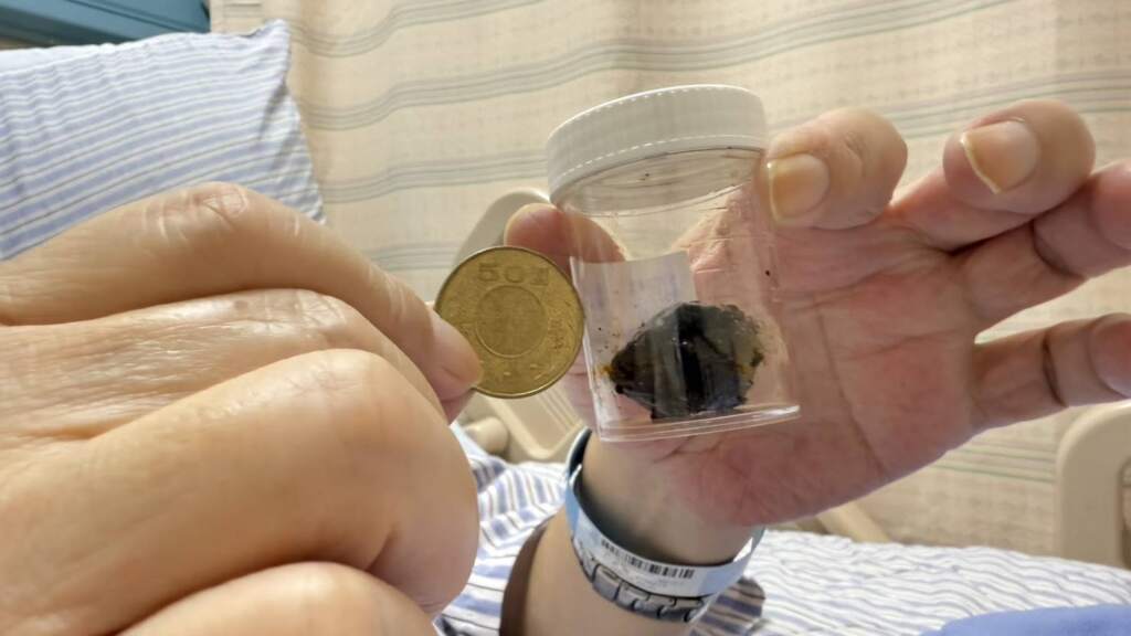 ▲吳先生經腹腔鏡膽囊切除術,將膽囊切除,並起出其中約3公分的結石。(圖/彰化醫院提供)