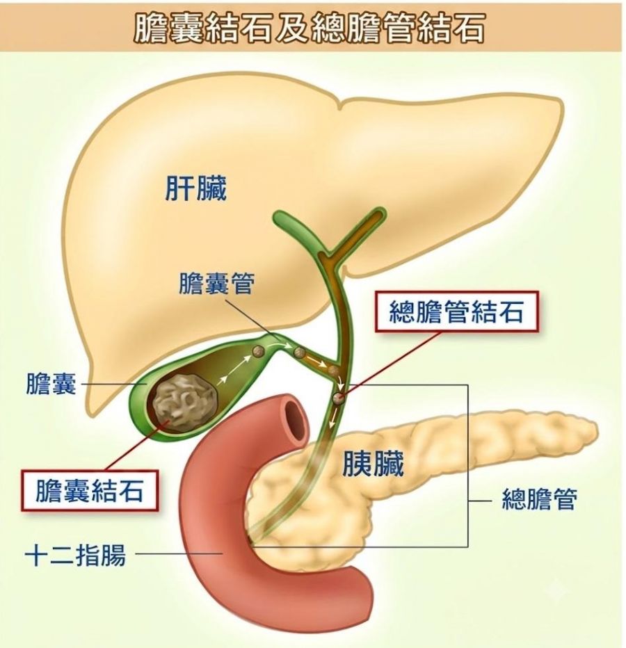 膽囊結石3公分沒事 但0.5公分總膽管結石竟爆敗血症致命危機