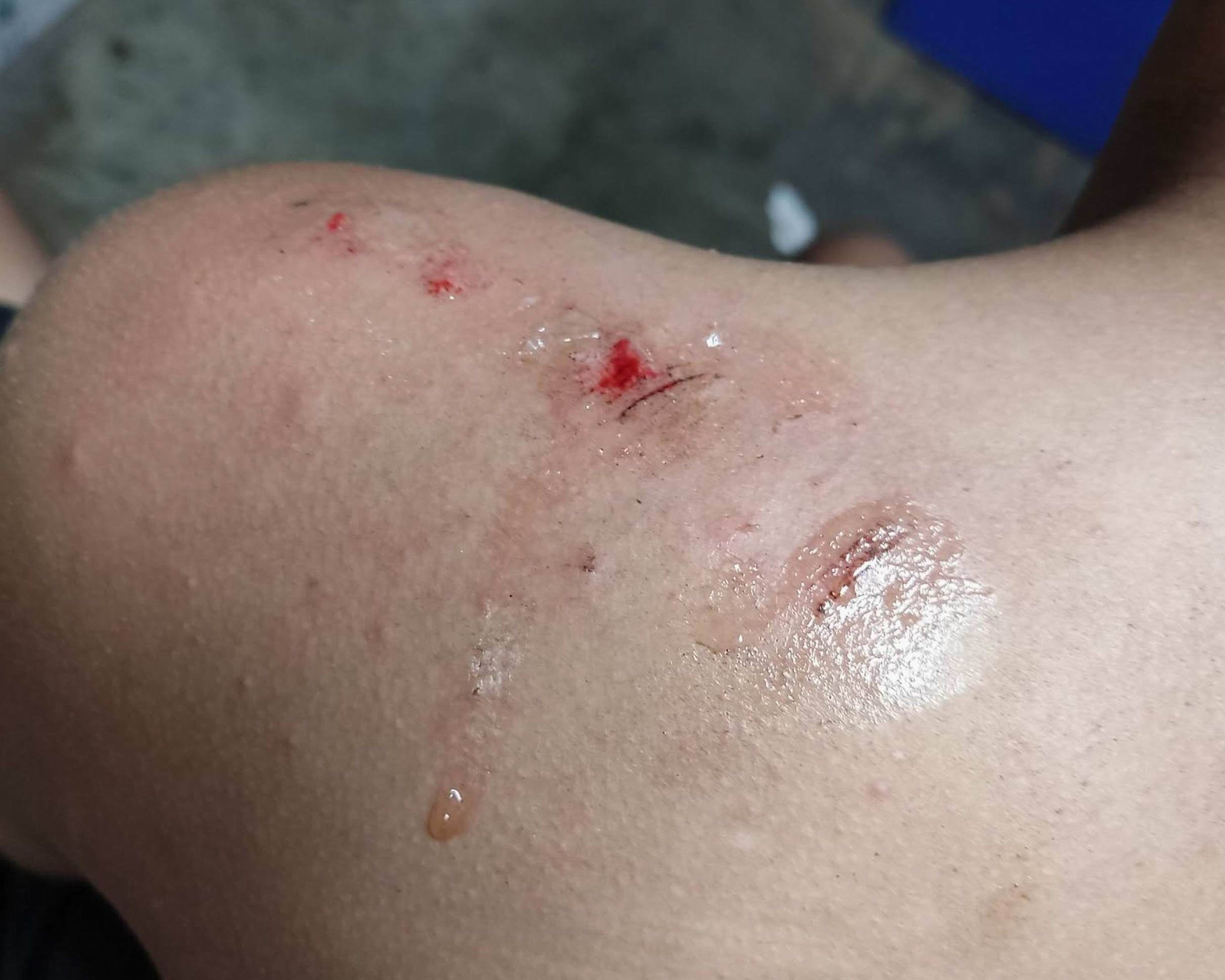 彰化市水尾二路驚傳狗群追人　男童傷痕累累逃回家