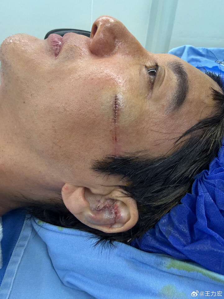 王力宏演唱時跌倒,縫了39針。(圖/翻攝王力宏微博)