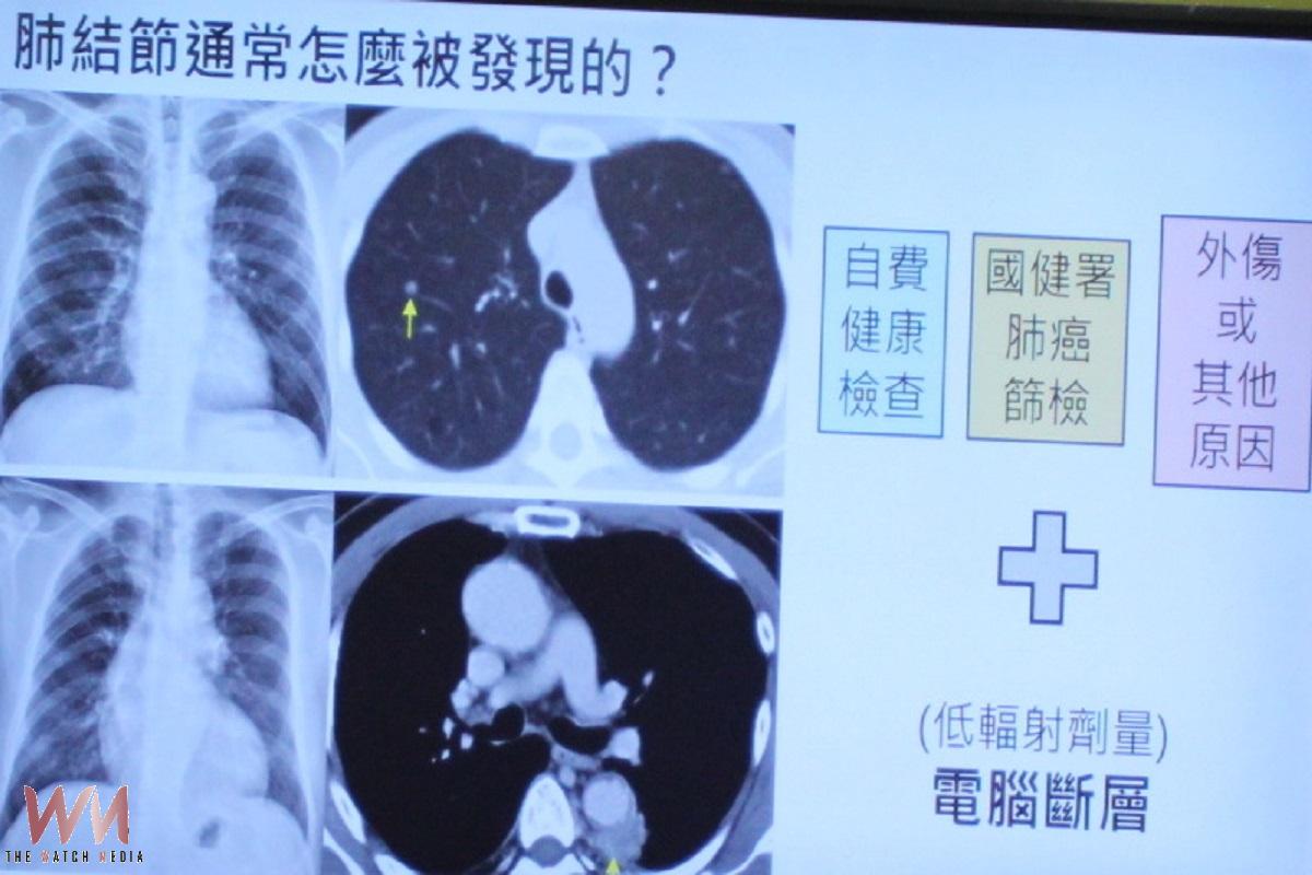 肺結節不等於肺癌莫恐慌    台大雲院精準診療劫後餘生