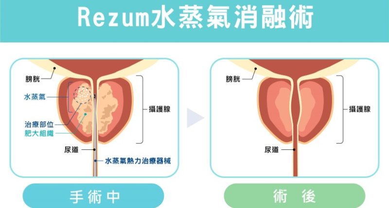 攝護腺肥大微創治療的新時代 Rezum水蒸氣消融與雷射攝護腺手術