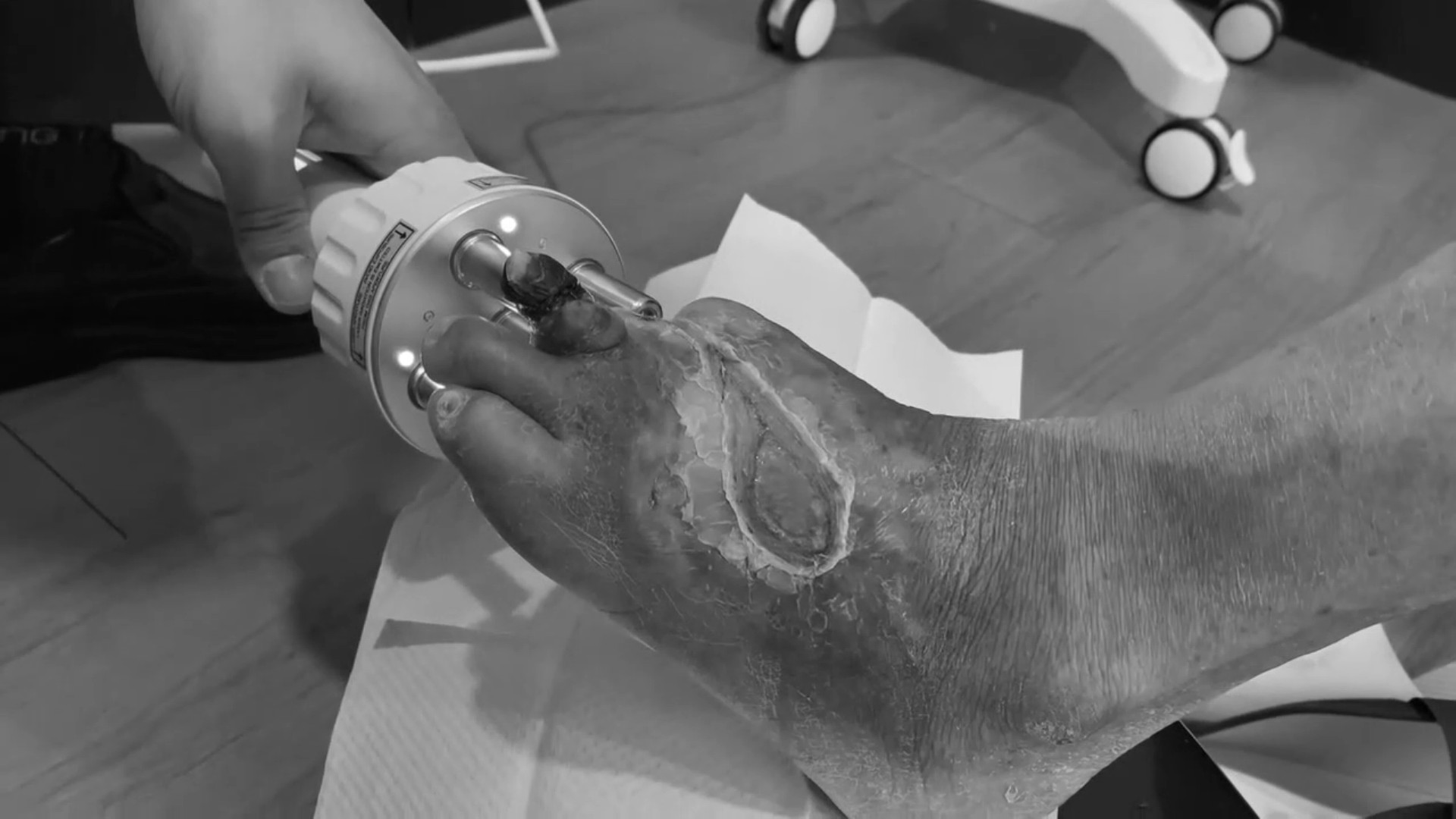 糖尿病腳趾傷口惡化截兩趾 中醫雷射針灸恢復行走 - https://www.watchmedia01.com