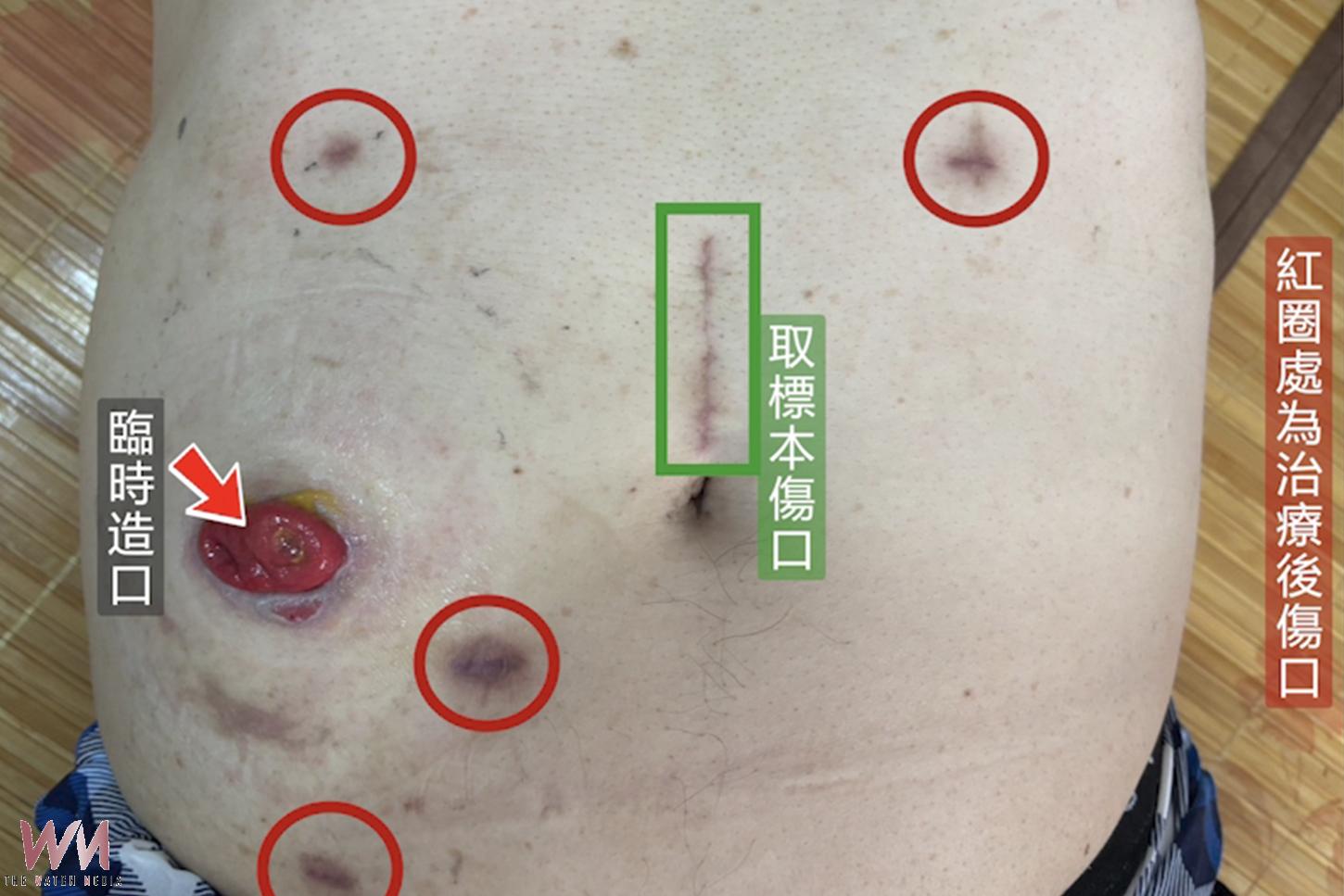 （有影片）／糞便潛血別輕忽！71歲男無感罹直腸癌　早檢救回健康 - https://www.watchmedia01.com