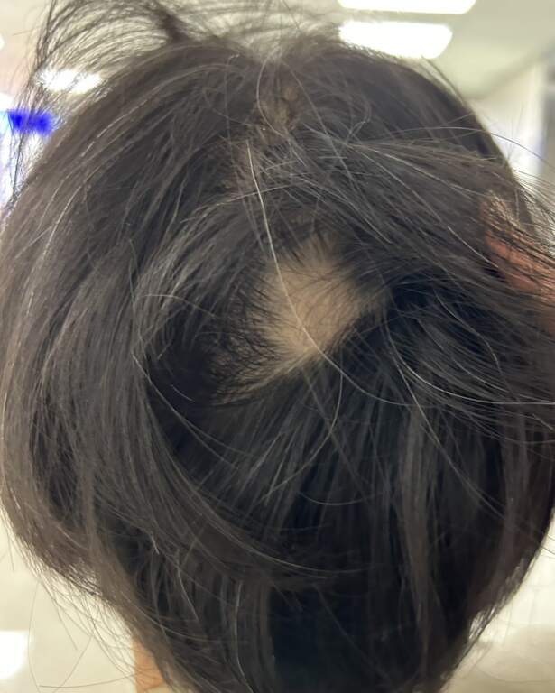 ▲圓禿是一種自體免疫疾病,當免疫系統異常活化,將毛囊誤認為外來物而加以攻擊時,便可能造成局部毛髮突然脫落(照片由蔡和熹醫師提供)