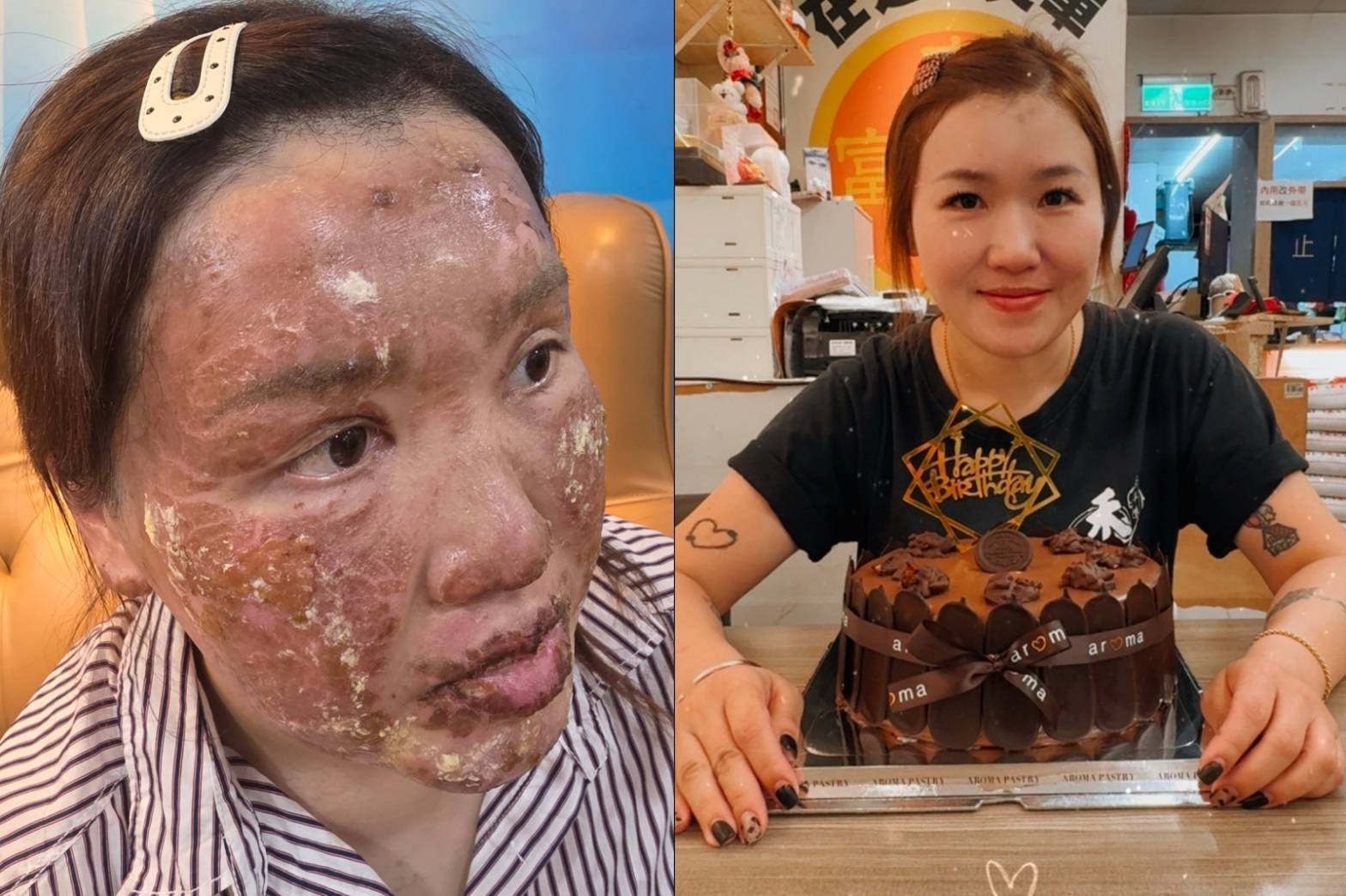 鄭女原本面容姣好(圖右),氣爆當下首當其衝幾近毀容(圖左)。(圖/民眾提供)