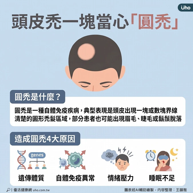 造成圓禿4大原因