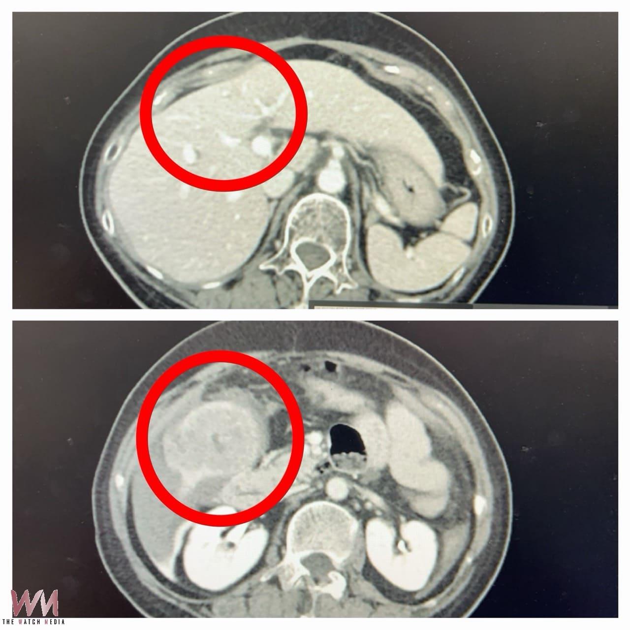 肝癌破裂大量出血命危 婦人鬼門關前撿回一命 微創手術成功逆轉人生 - https://www.watchmedia01.com