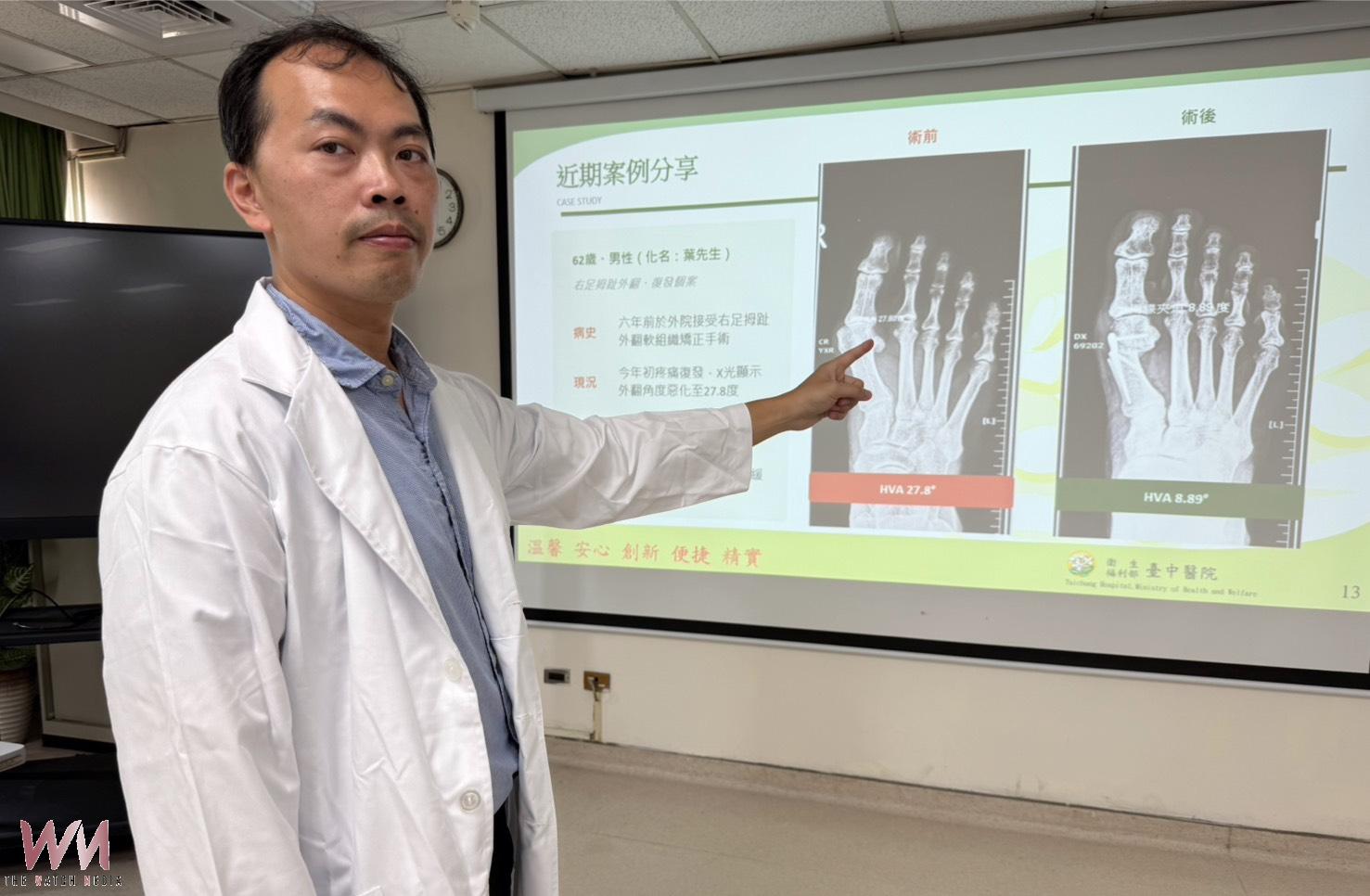拇指外翻反覆疼痛別忍 醫:中重度患者可評估截骨矯正手術 - https://www.watchmedia01.com