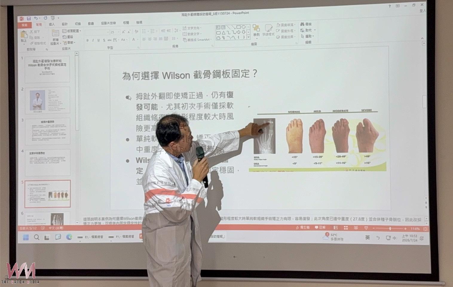 拇指外翻反覆疼痛別忍 醫:中重度患者可評估截骨矯正手術 - https://www.watchmedia01.com