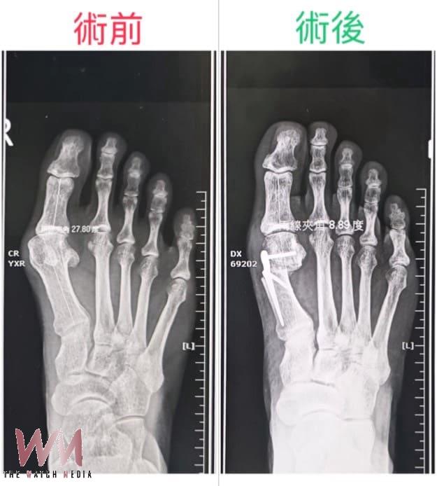 拇指外翻反覆疼痛別忍 醫:中重度患者可評估截骨矯正手術 - https://www.watchmedia01.com