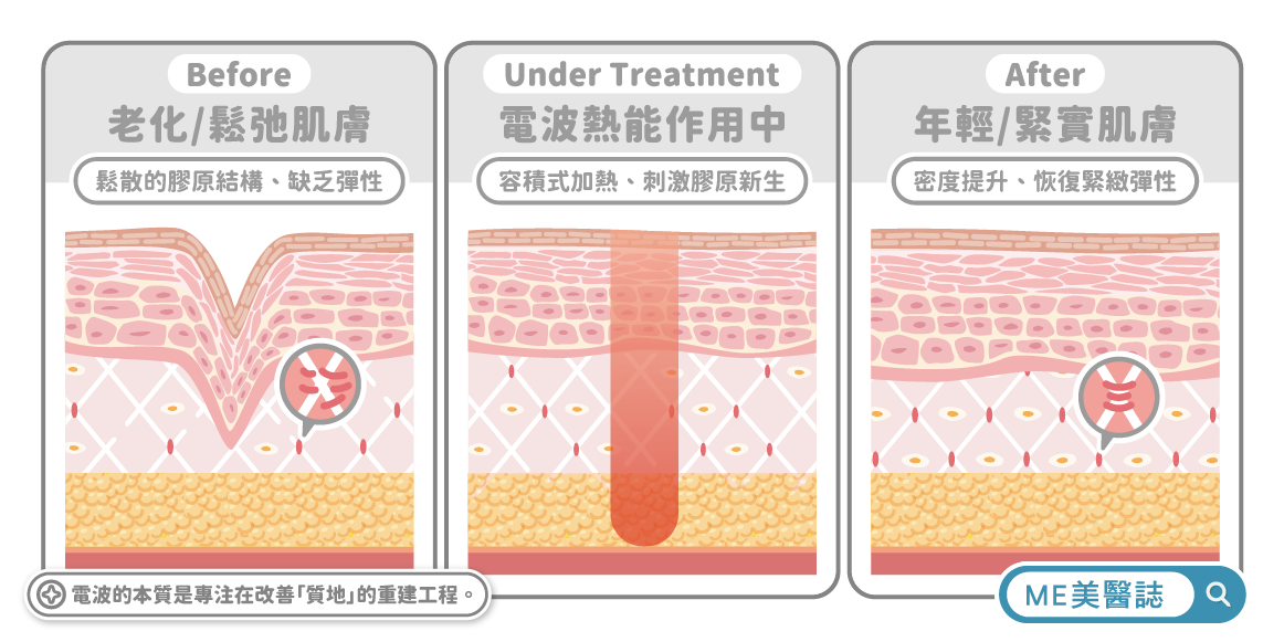 電波療程的作用