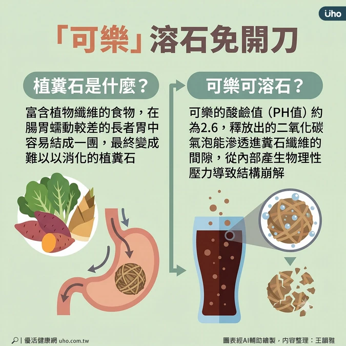 「可樂」溶石免開刀