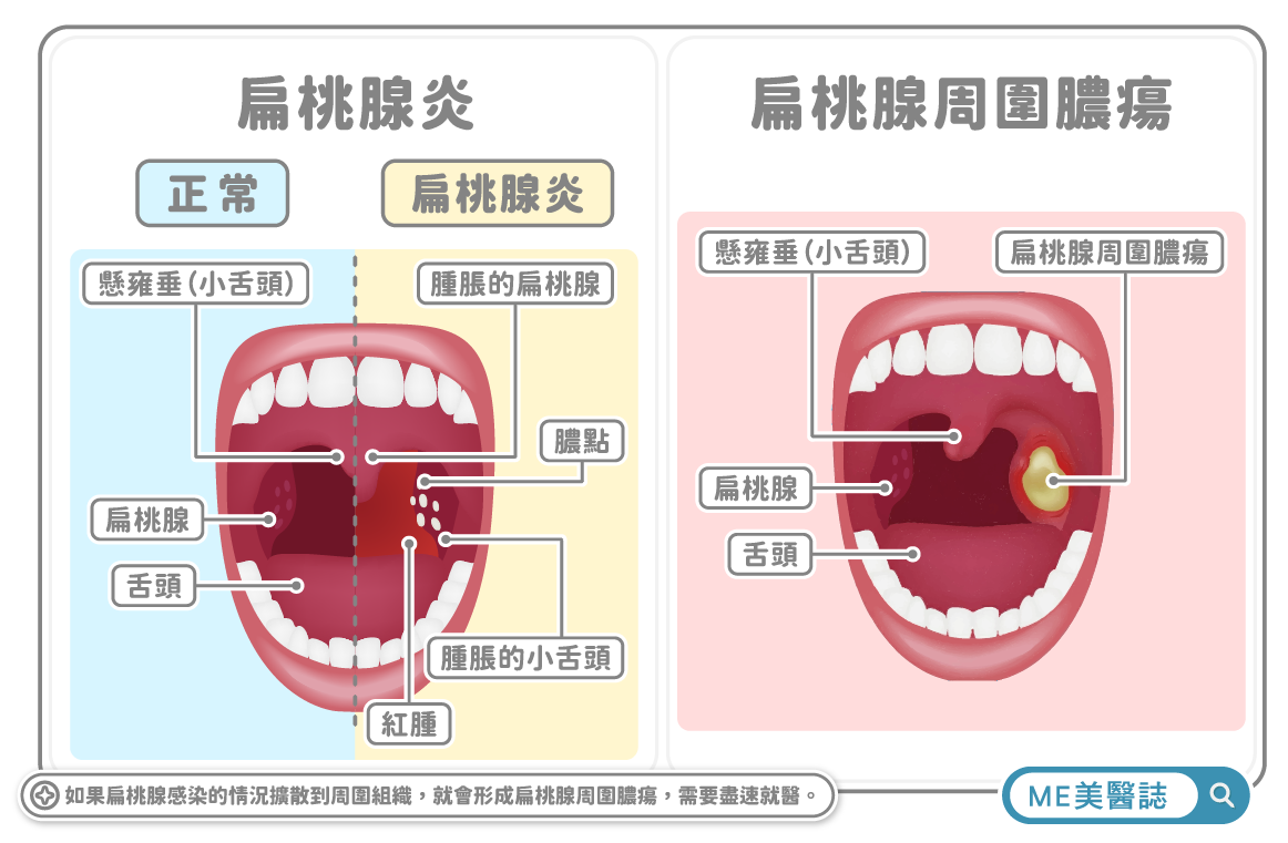 頸部的深層感染