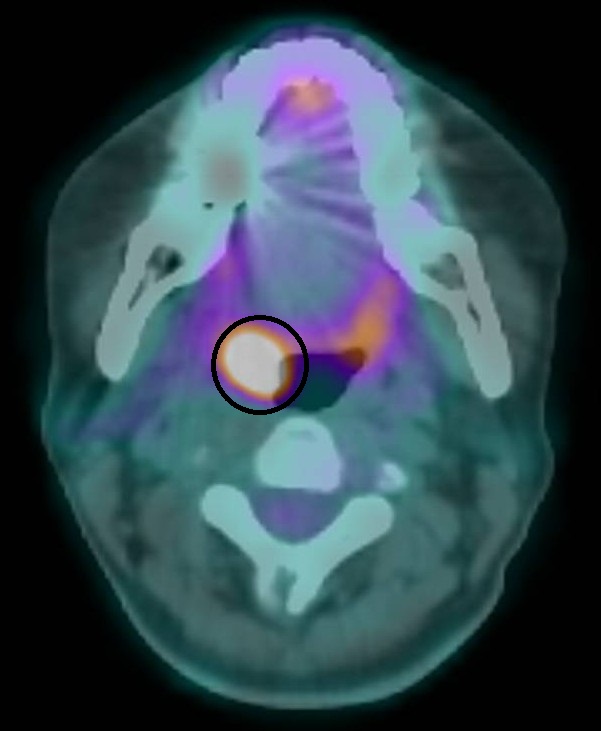 SQ08075 7真相曝光！女性罹口咽癌罕見案例
