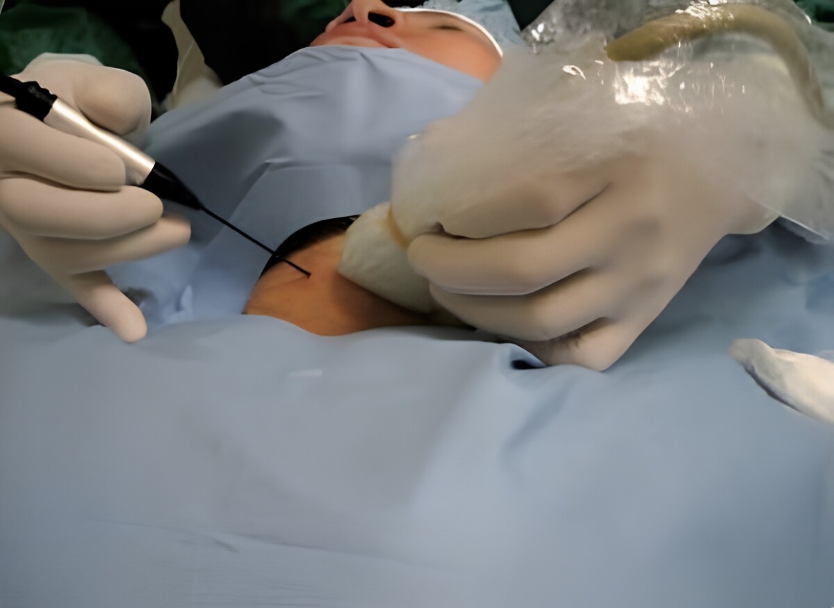 SQ08125 8甲狀腺良性結節還有RFA可選
