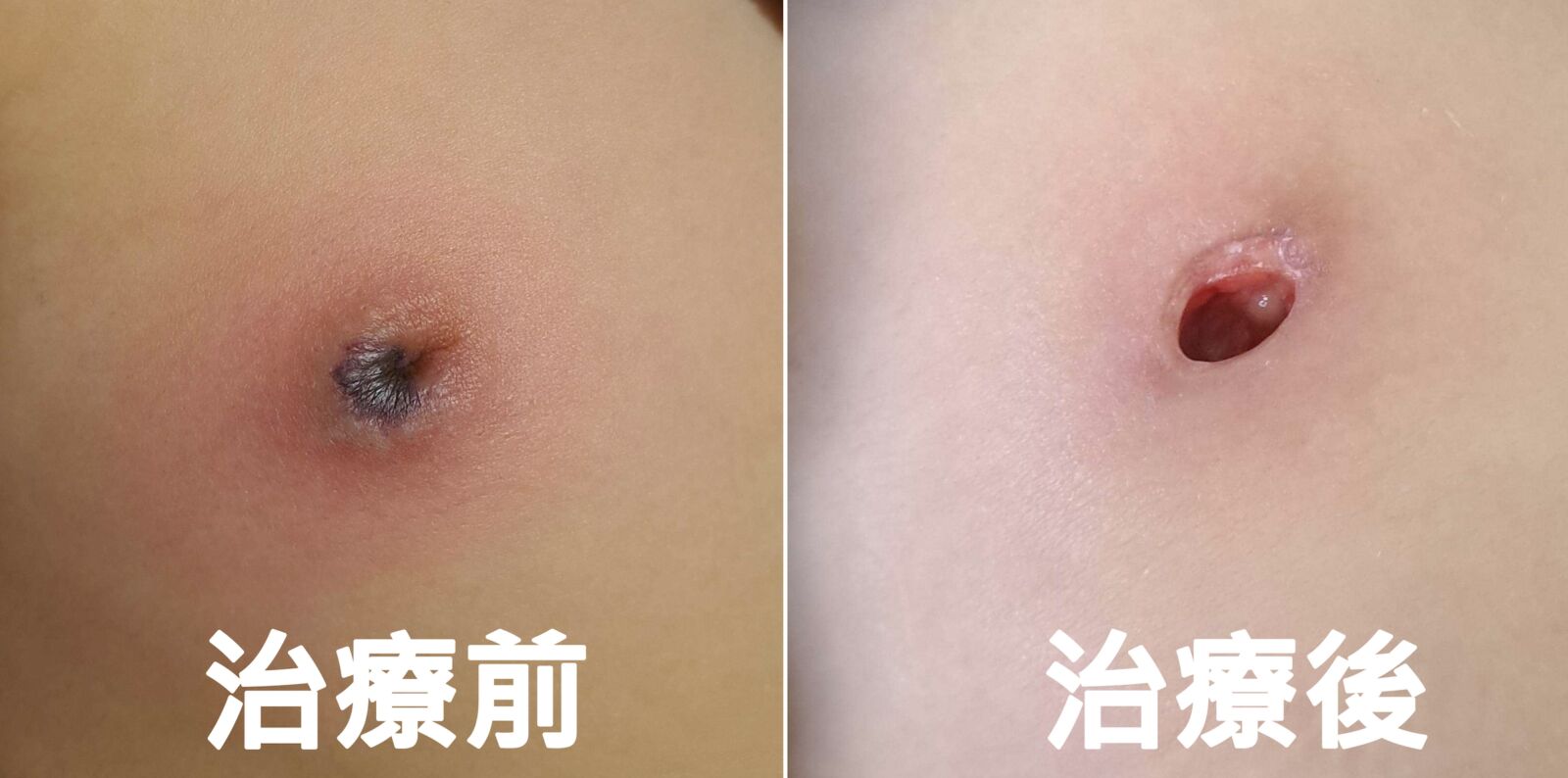 小一女童傷口感染綠膿桿菌 乳頭「幾乎被吃光」! 228 小一女童傷口感染綠膿桿菌 乳頭「幾乎被吃光」! 227