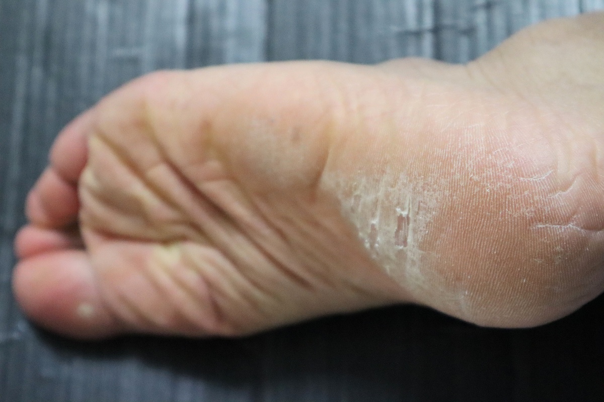 腳後跟變粗、長硬塊恐是「膽固醇過高」！醫示警3大異常  眼皮長黃斑也中招