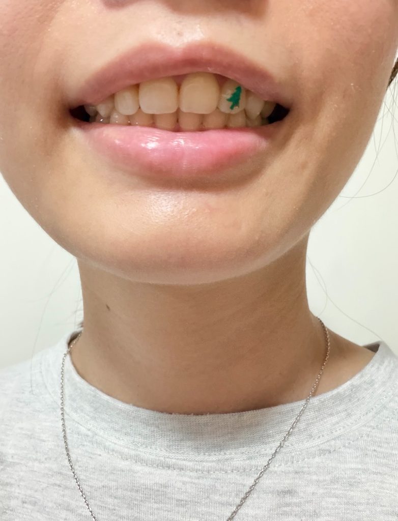 女網友牙齒貼這東西出門 老爸皺眉:怎麼卡那麼大一片菜? 女網友牙齒貼這東西出門 老爸皺眉:怎麼卡那麼大一片菜?